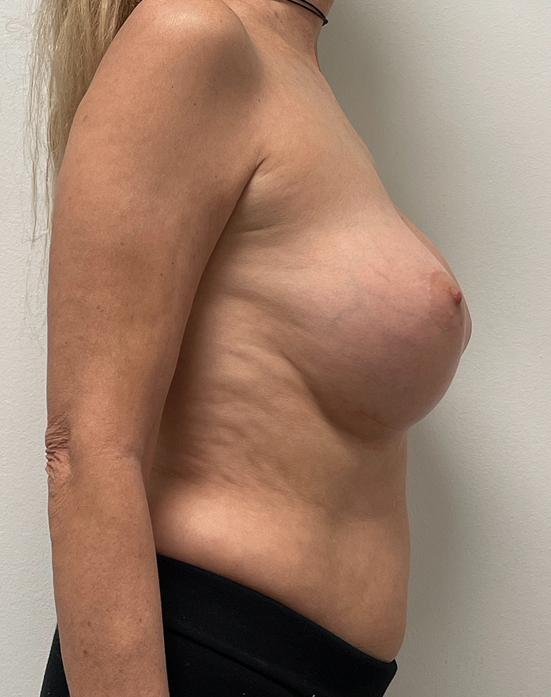 Breast Aug Before and After | Rashid Plastic Surgery