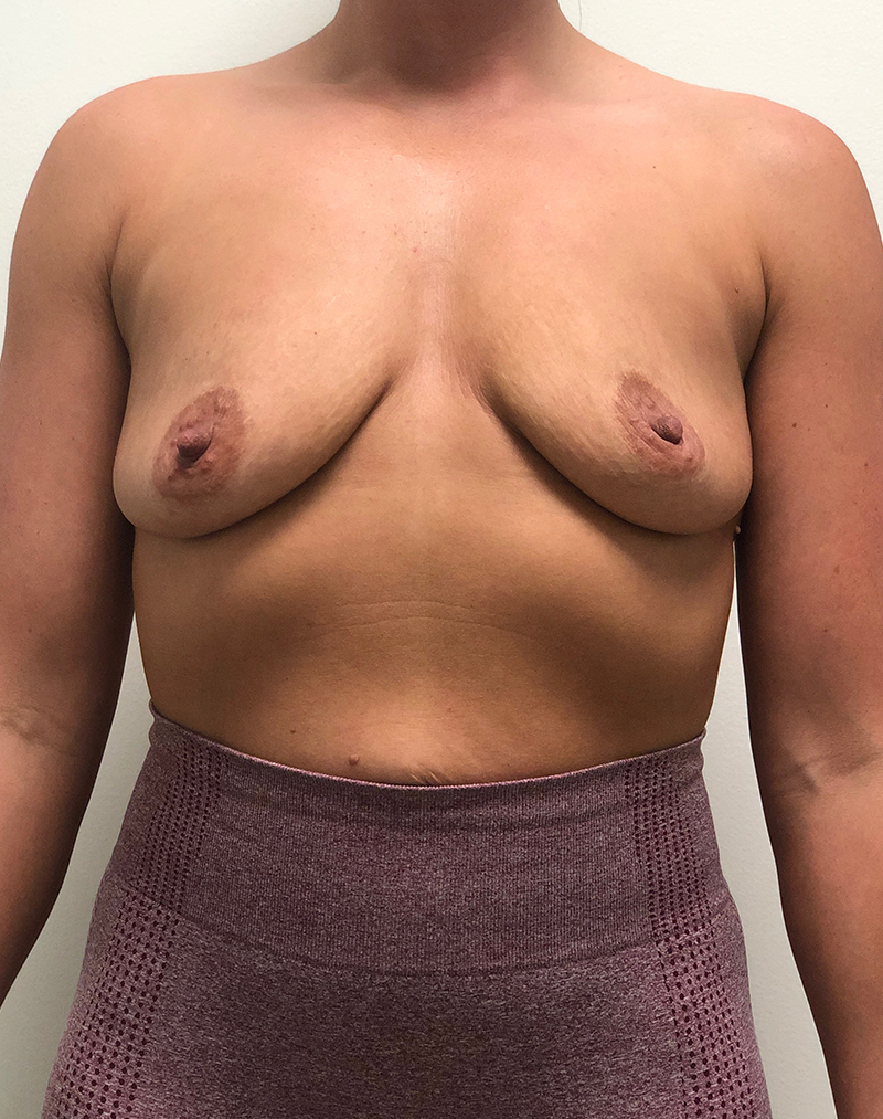 Breast Aug Before and After | Rashid Plastic Surgery