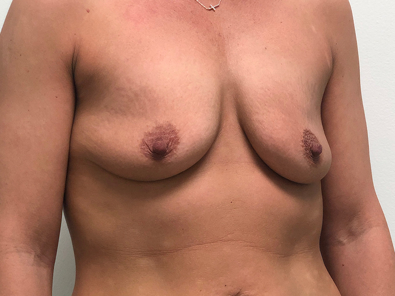 Breast Aug Before and After | Rashid Plastic Surgery