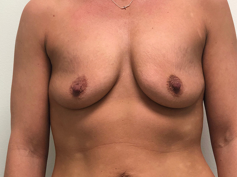 Breast Aug Before and After | Rashid Plastic Surgery