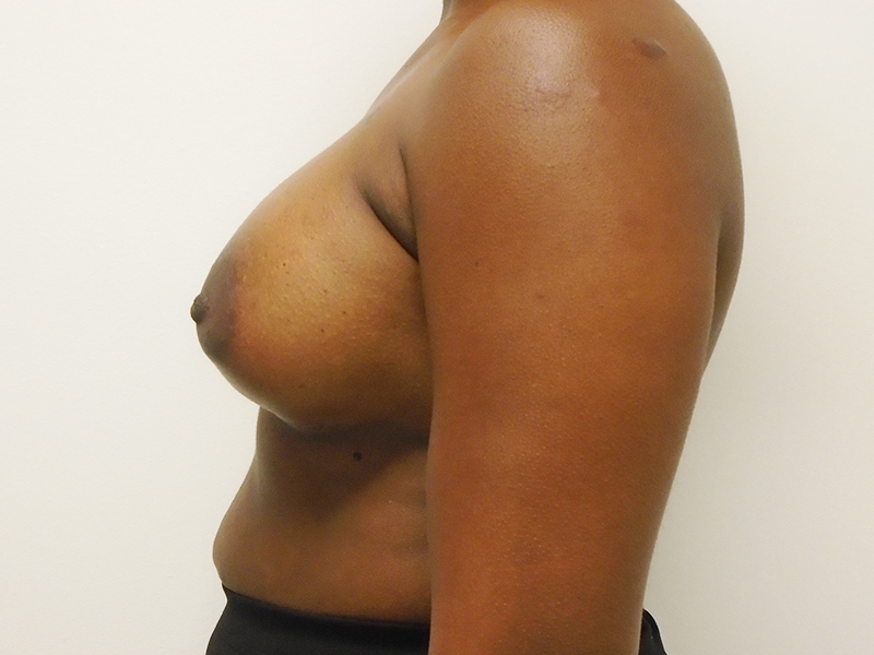 Breast Aug Before and After | Rashid Plastic Surgery