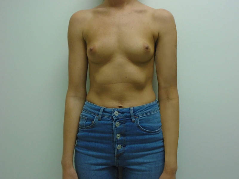 Breast Aug Before and After | Rashid Plastic Surgery