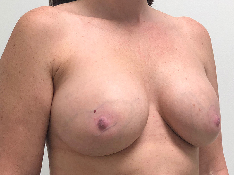 Breast Implant Exchange Before and After | Rashid Plastic Surgery
