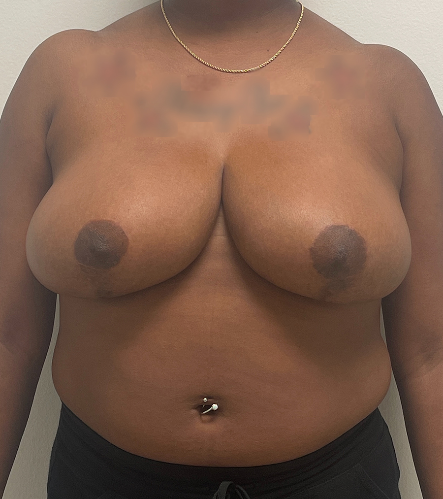 Breast Reduction Before and After | Rashid Plastic Surgery
