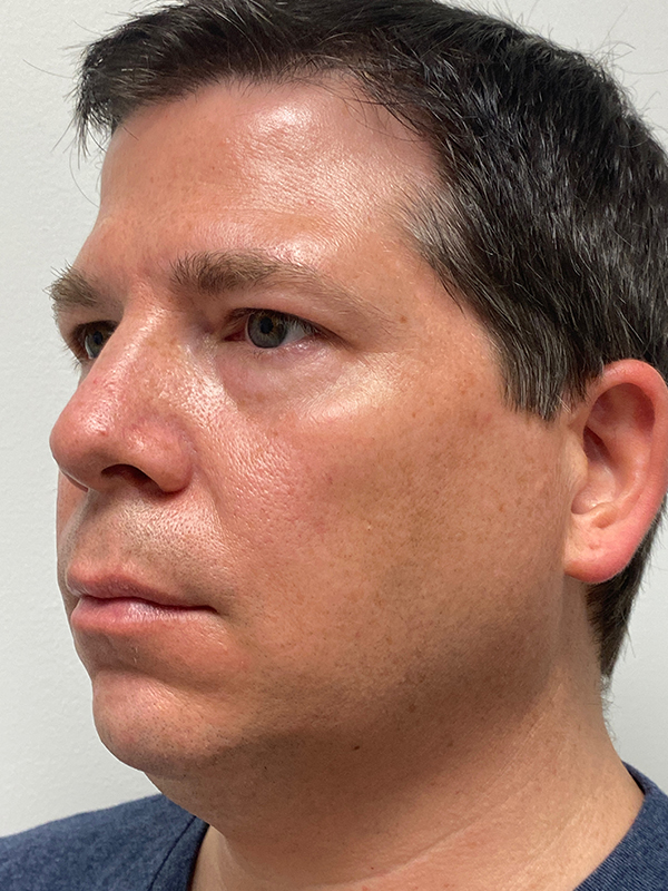 Chin Augmentation Before and After | Rashid Putman Plastic Surgery