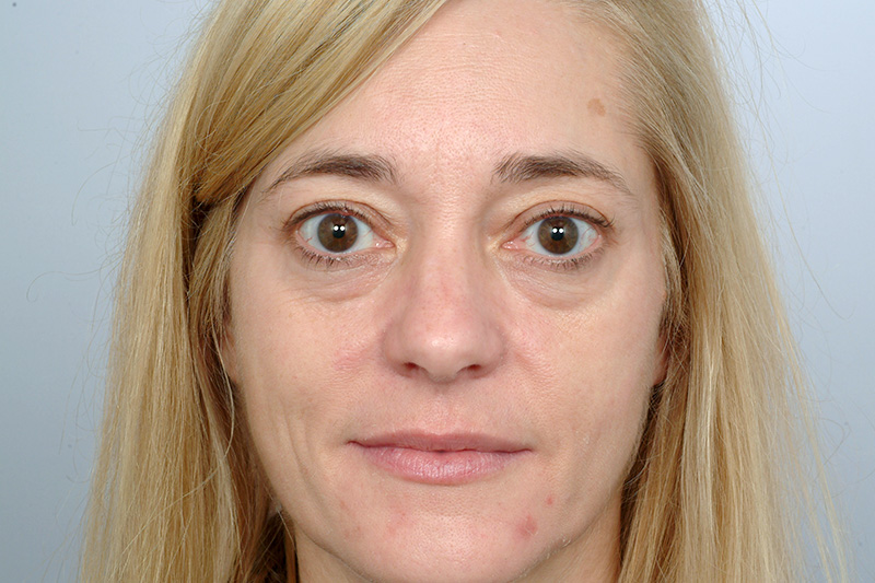 Facelift With Blepharoplasty Before and After | Rashid Plastic Surgery