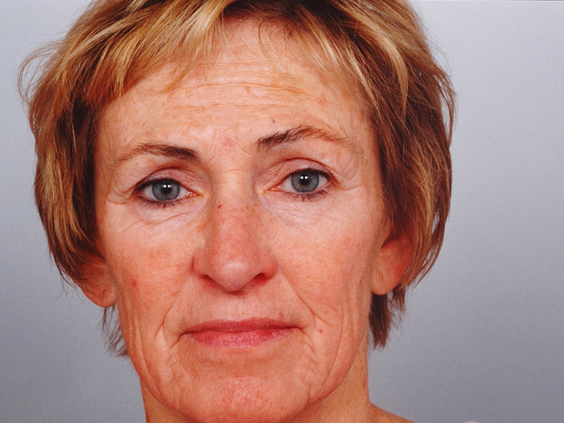 Facelift With Blepharoplasty Before and After | Rashid Plastic Surgery