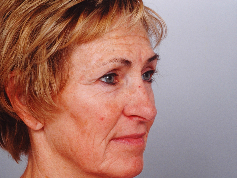Facelift With Blepharoplasty Before and After | Rashid Putman Plastic Surgery