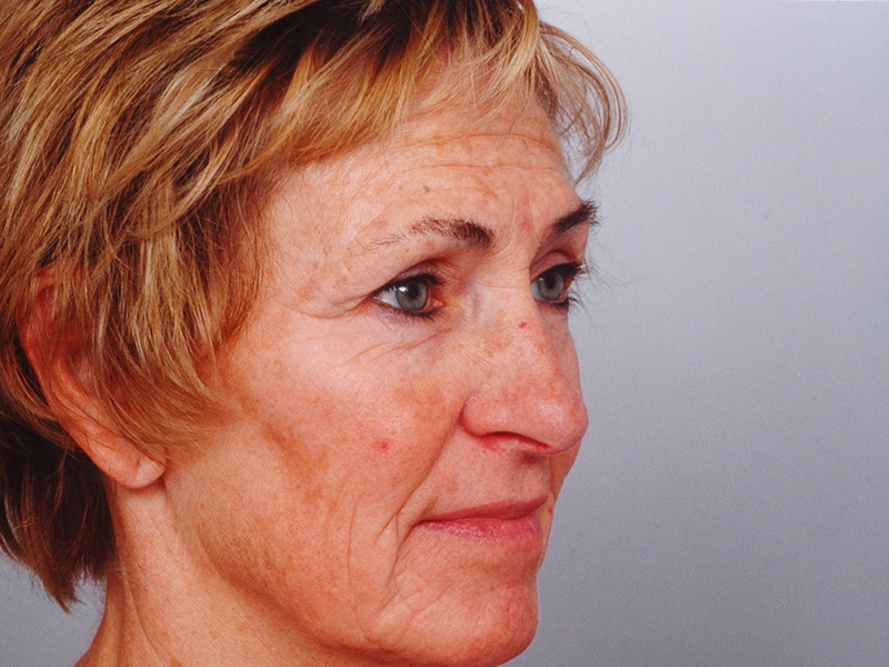 Facelift With Blepharoplasty Before and After | Rashid Plastic Surgery