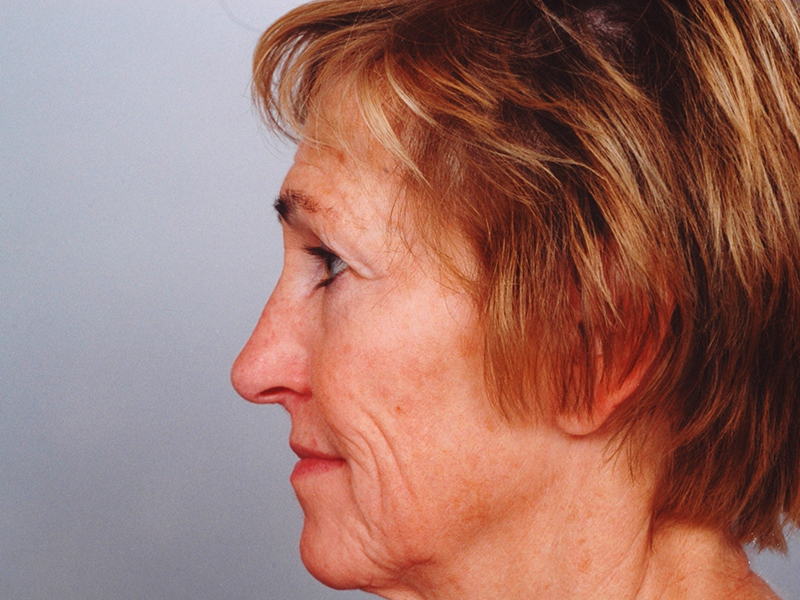 Facelift With Blepharoplasty Before and After | Rashid Plastic Surgery