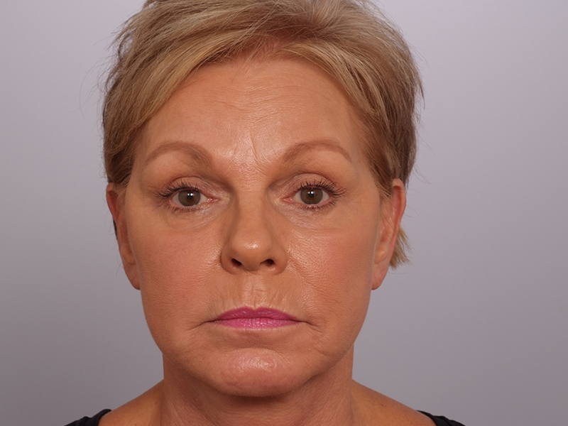 Facelift With Blepharoplasty Before and After | Rashid Plastic Surgery