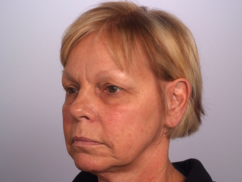 Facelift With Blepharoplasty Before and After | Rashid Putman Plastic Surgery