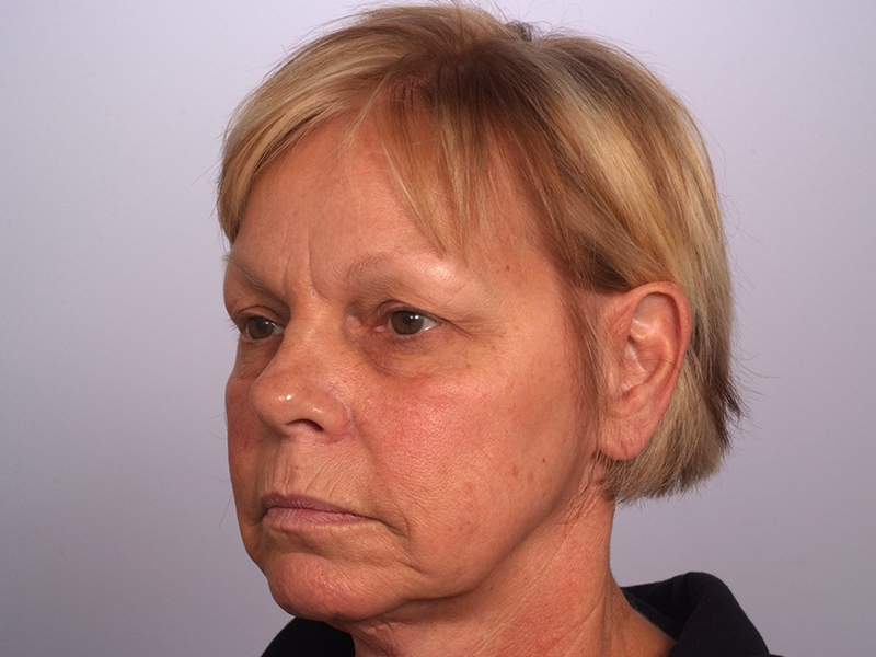 Facelift With Blepharoplasty Before and After | Rashid Plastic Surgery