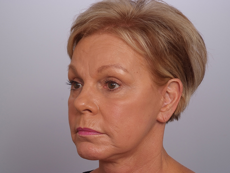 Facelift With Blepharoplasty Before and After | Rashid Plastic Surgery