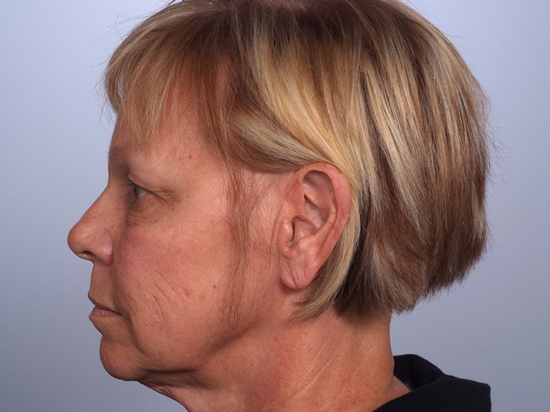 Facelift With Blepharoplasty Before and After | Rashid Putman Plastic Surgery