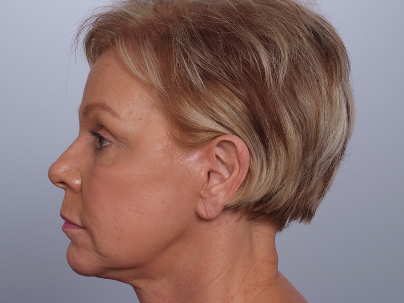 Facelift With Blepharoplasty Before and After | Rashid Plastic Surgery