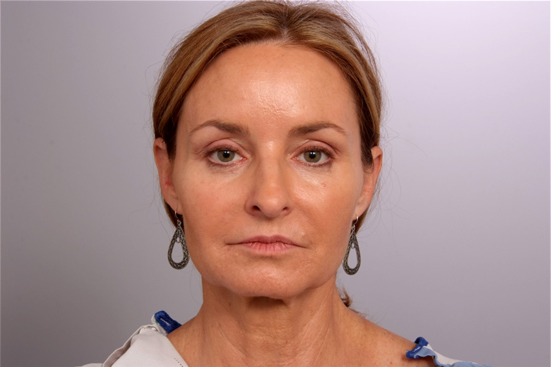 Facelift Before and After | Rashid Plastic Surgery