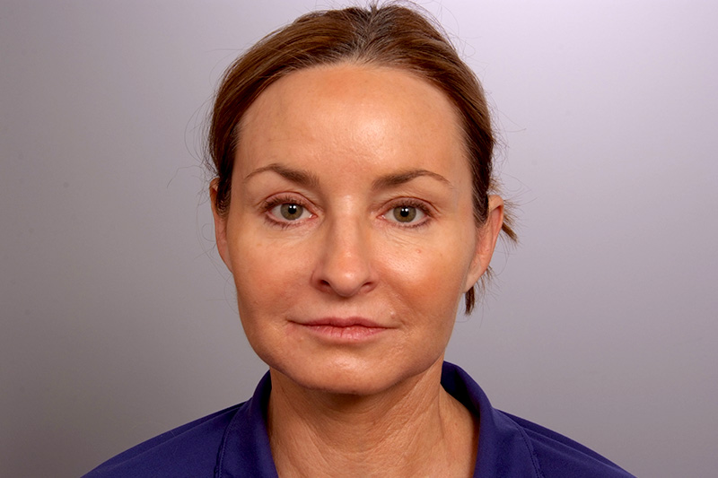 Facelift Before and After | Rashid Plastic Surgery