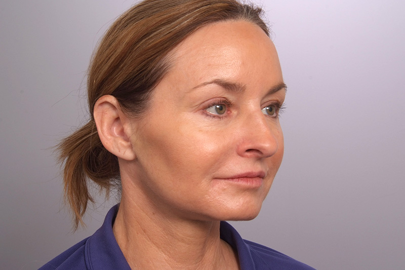 Facelift Before and After | Rashid Plastic Surgery