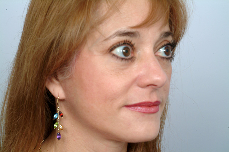 Facelift Before and After | Rashid Plastic Surgery