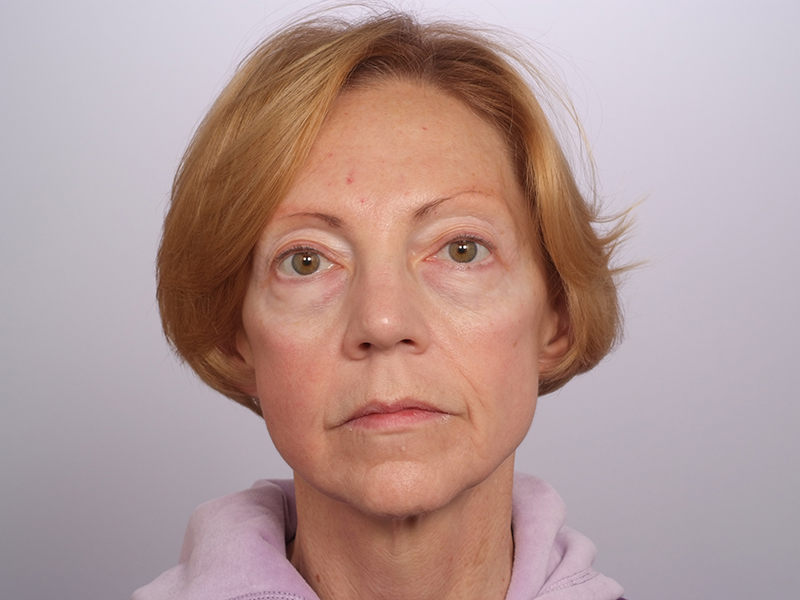 Facelift Before and After | Rashid Plastic Surgery