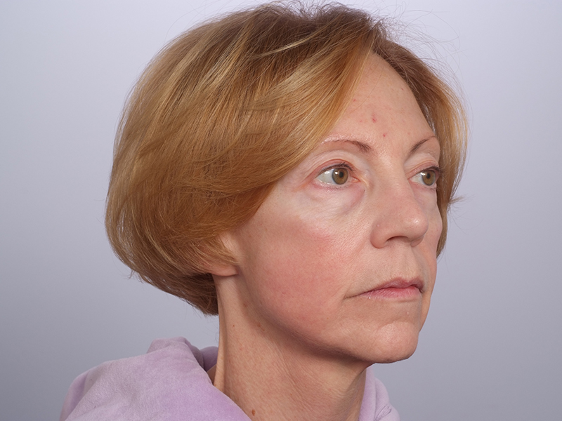 Facelift Before and After | Rashid Plastic Surgery