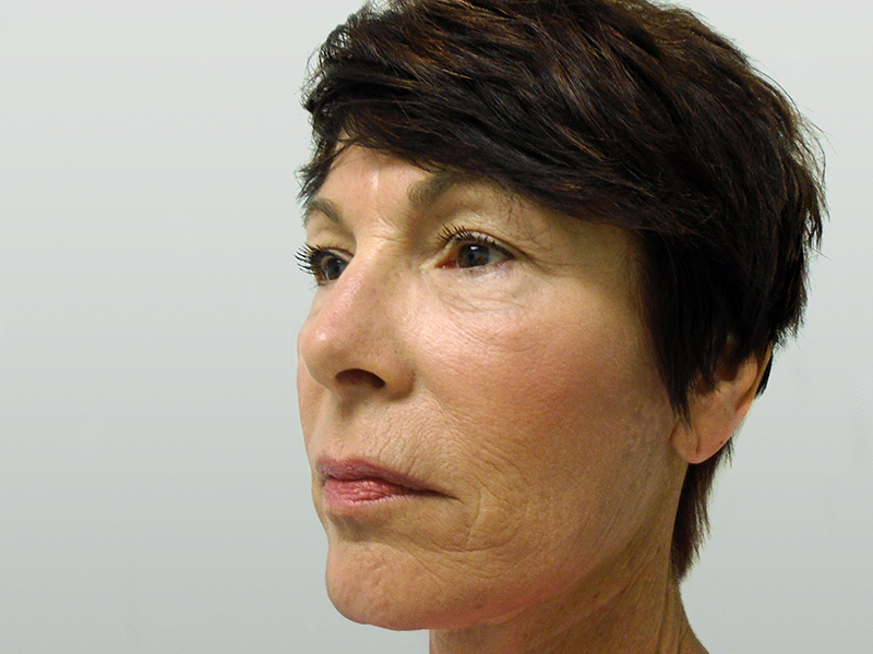 Facelift Before and After | Rashid Plastic Surgery