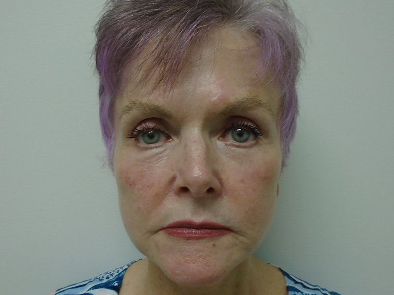 Facelift Before and After | Rashid Plastic Surgery