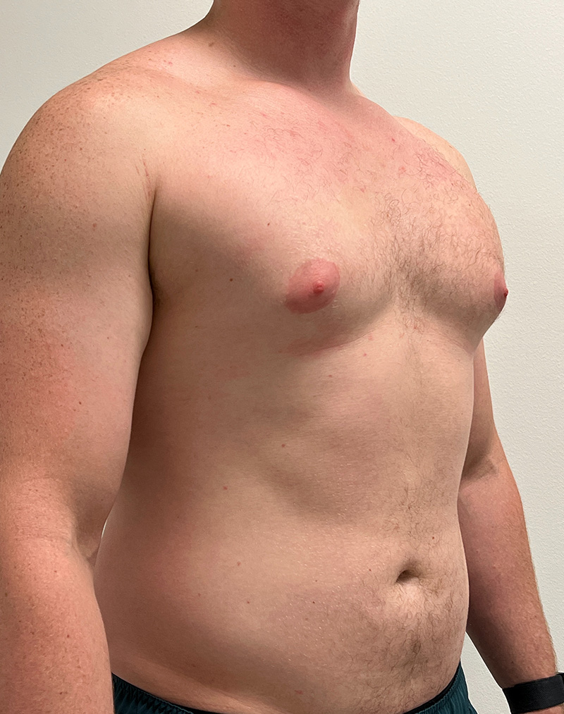 Gynecomastia Before and After | Rashid Plastic Surgery