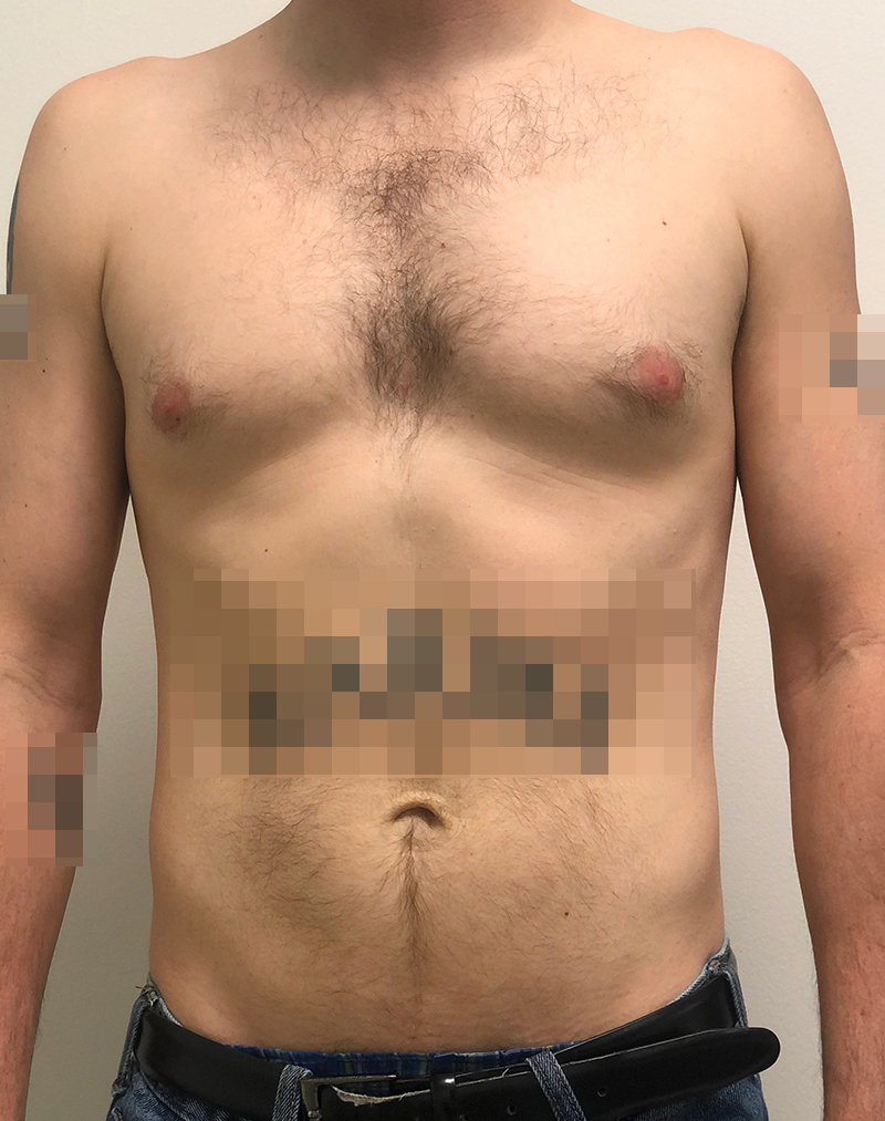Gynecomastia Before and After | Rashid Putman Plastic Surgery