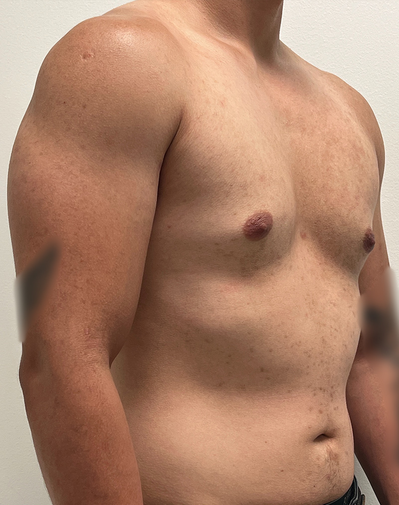 Gynecomastia Before and After | Rashid Plastic Surgery