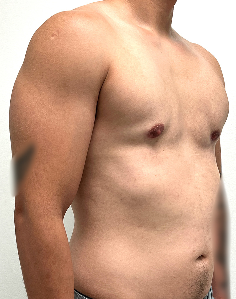 Gynecomastia Before and After | Rashid Plastic Surgery