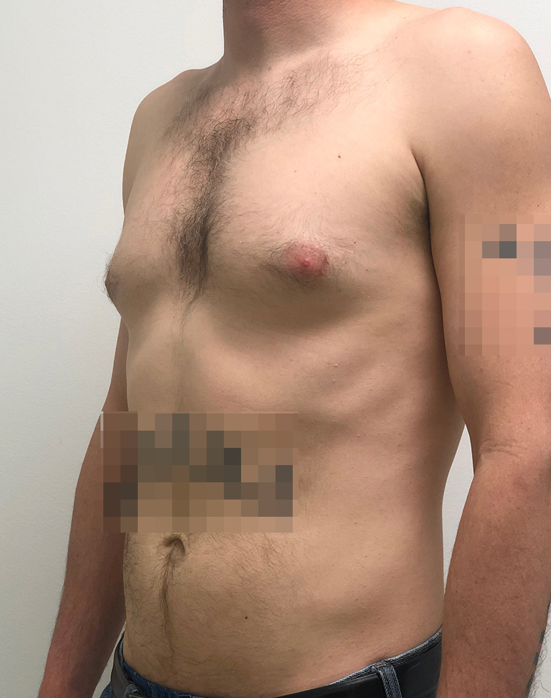 Gynecomastia Before and After | Rashid Plastic Surgery