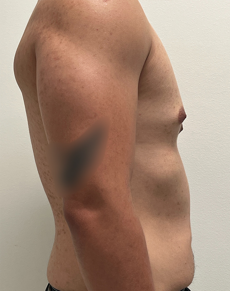 Gynecomastia Before and After | Rashid Plastic Surgery