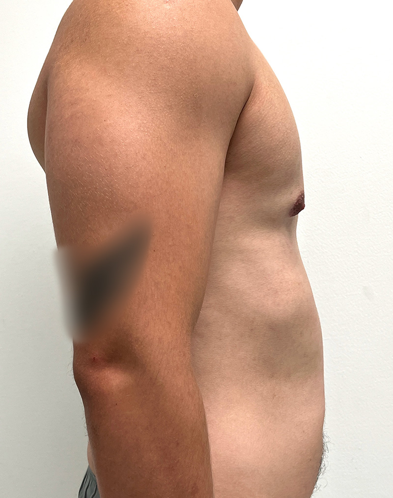 Gynecomastia Before and After | Rashid Plastic Surgery