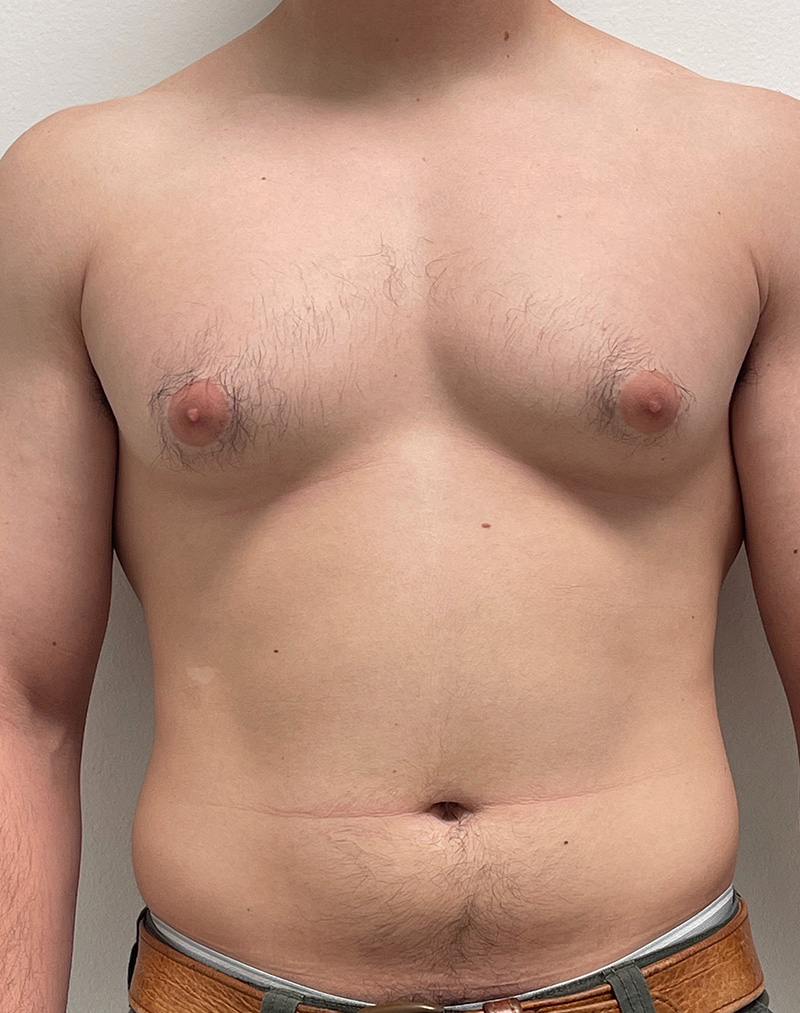 Gynecomastia Before and After | Rashid Plastic Surgery