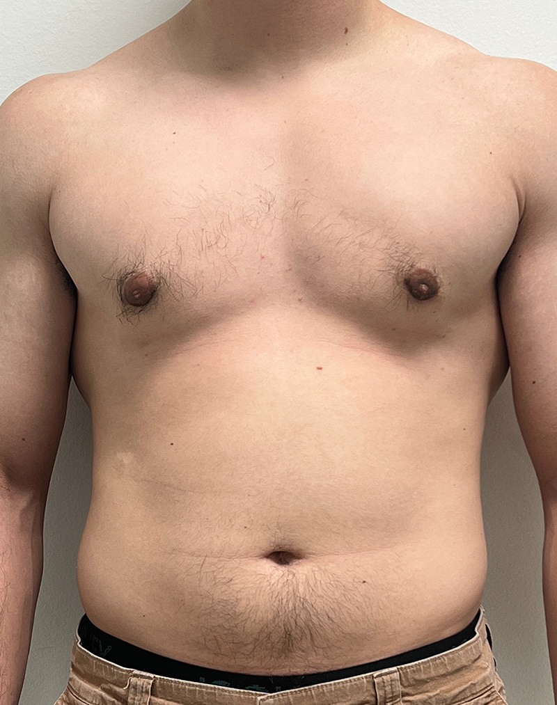 Gynecomastia Before and After | Rashid Plastic Surgery