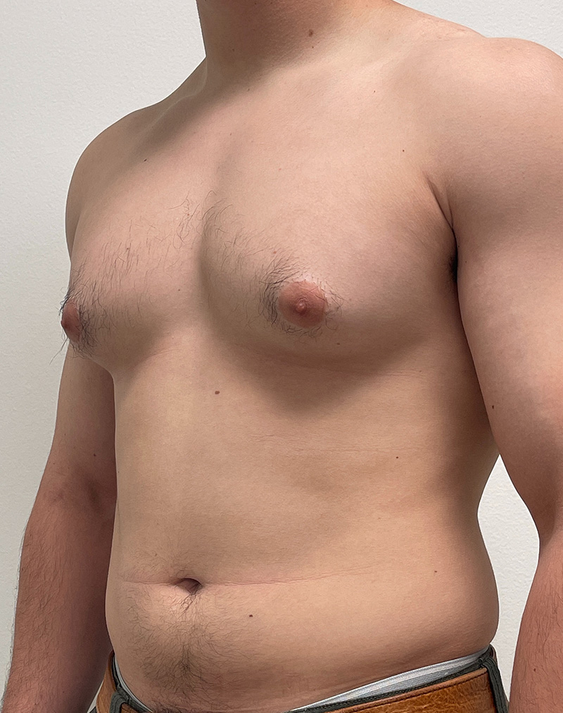 Gynecomastia Before and After | Rashid Plastic Surgery