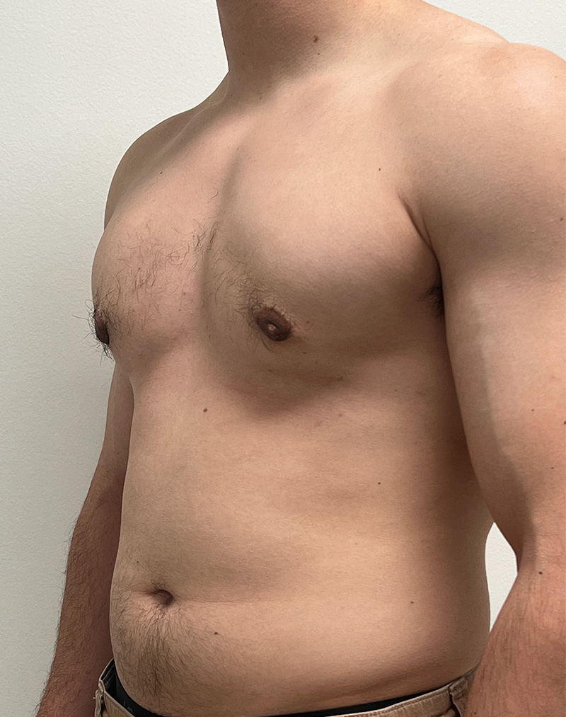 Gynecomastia Before and After | Rashid Plastic Surgery