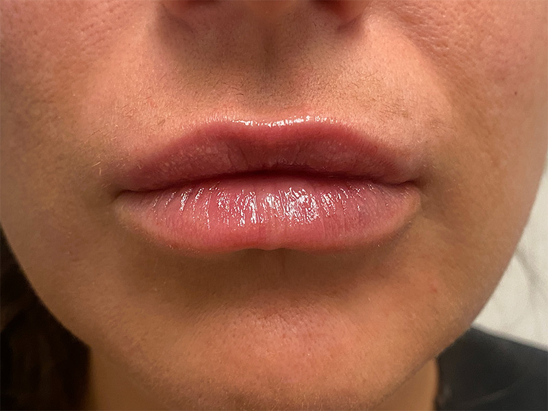 Lip Filler Before and After | Rashid Plastic Surgery