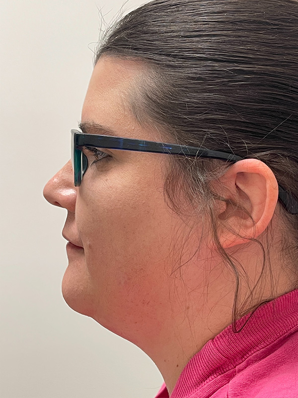 Neck Liposuction Before and After | Rashid Plastic Surgery