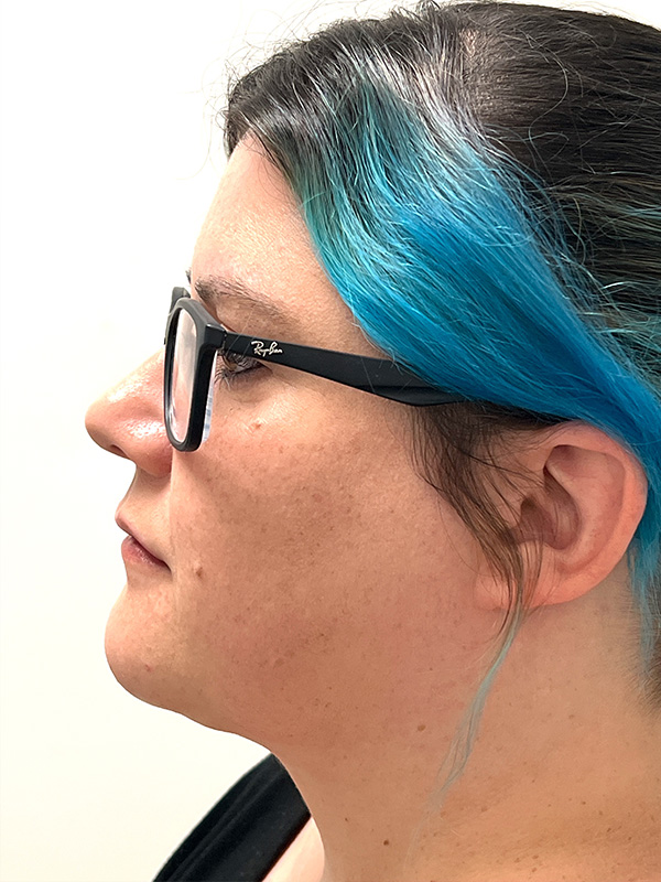 Neck Liposuction Before and After | Rashid Plastic Surgery