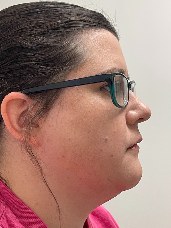 Neck Liposuction Before and After | Rashid Plastic Surgery