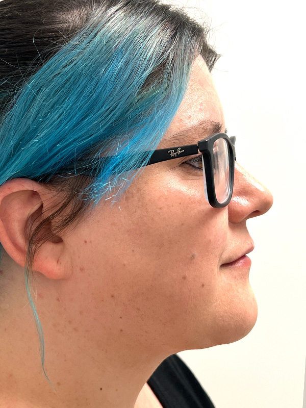 Neck Liposuction Before and After | Rashid Plastic Surgery