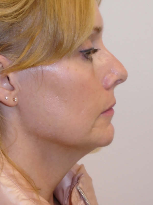 Necklift Before and After | Rashid Plastic Surgery