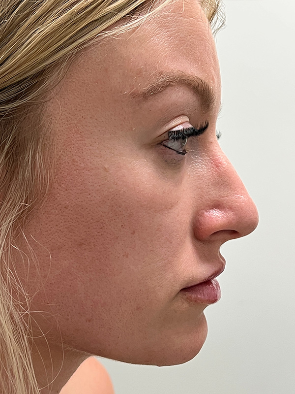 Rhinoplasty Before and After | Rashid Plastic Surgery