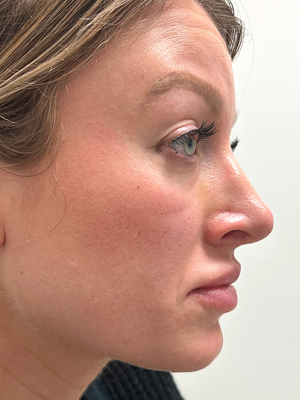 Rhinoplasty Before and After | Rashid Plastic Surgery