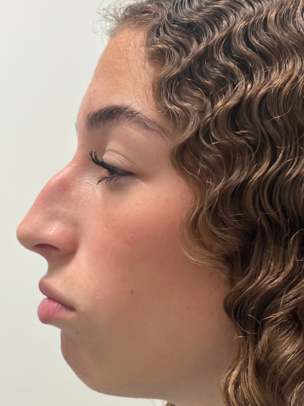 Rhinoplasty Before and After | Rashid Plastic Surgery