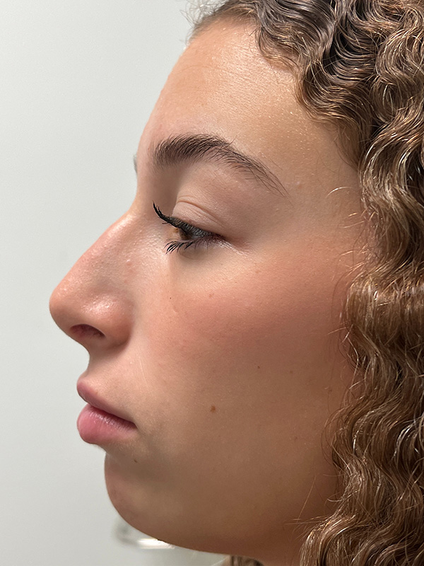 Rhinoplasty Before and After | Rashid Plastic Surgery