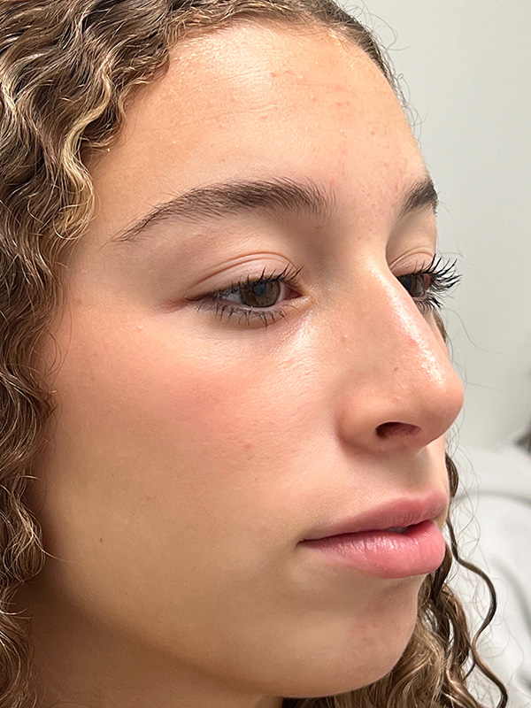 Rhinoplasty Before and After | Rashid Plastic Surgery